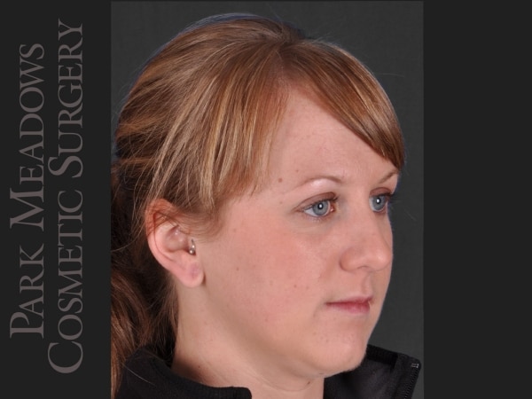 After Image: Ear Gauge Repair - right-front-oblique
