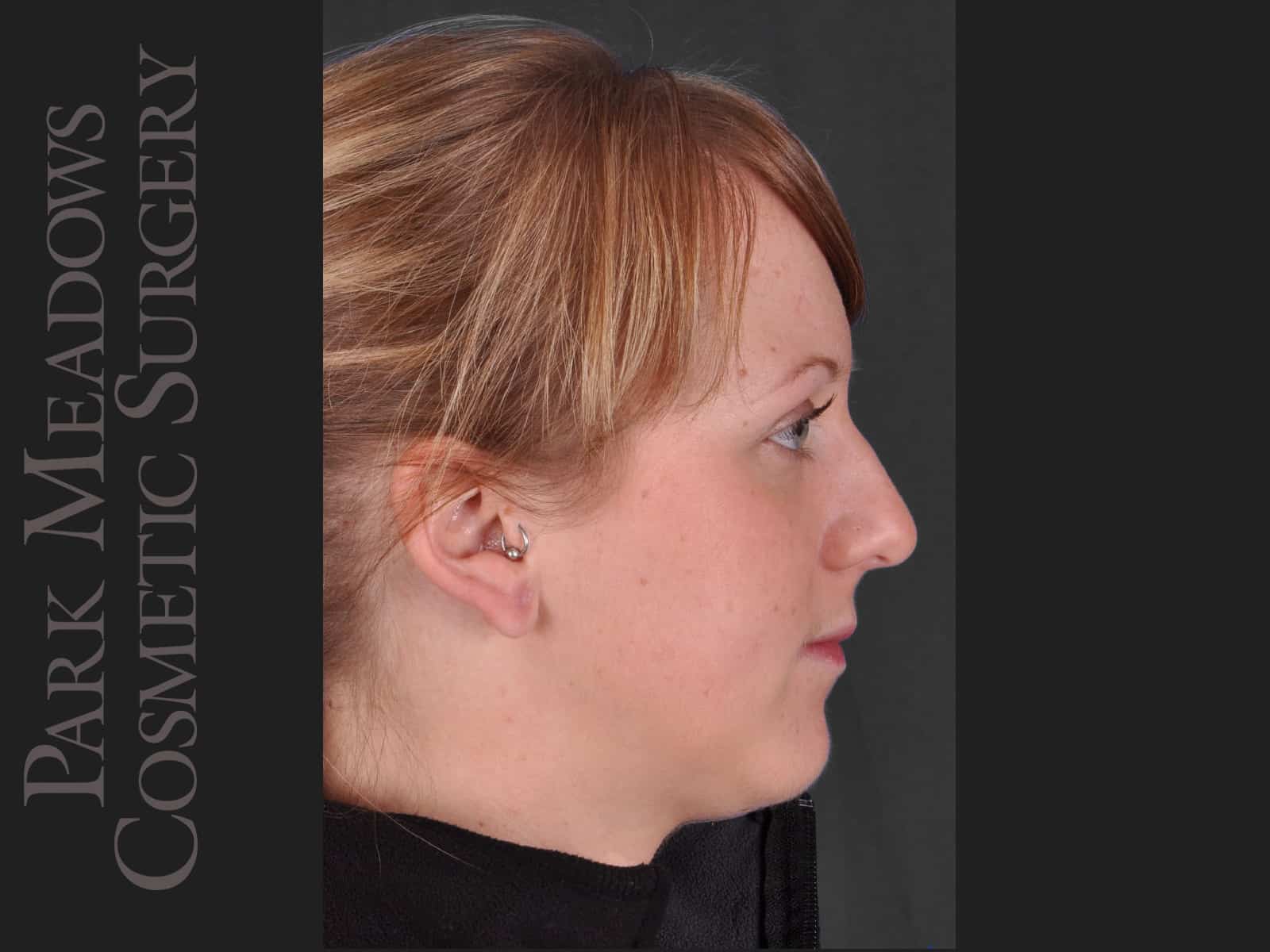 After Image: Ear Gauge Repair - right-side