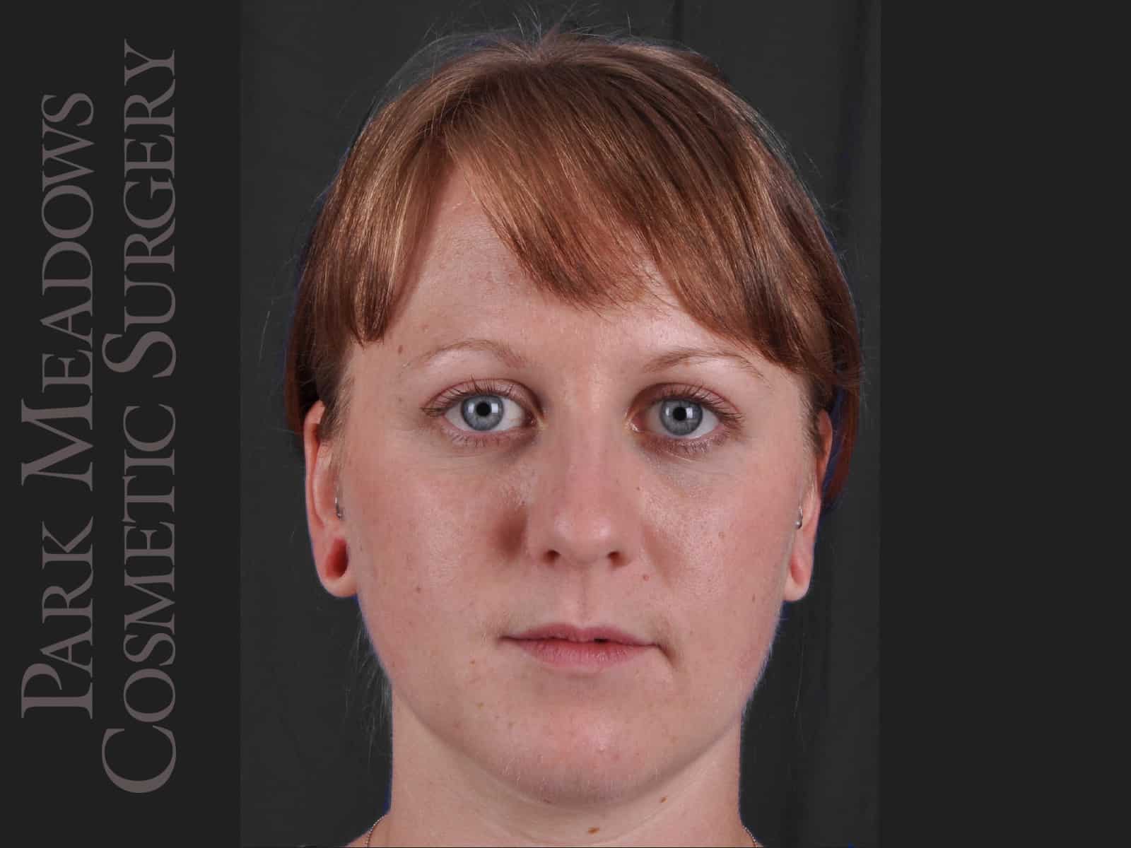 Before Image: Ear Gauge Repair - front