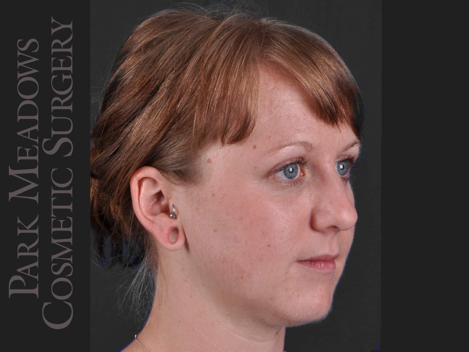 Before Image: Ear Gauge Repair - right-front-oblique