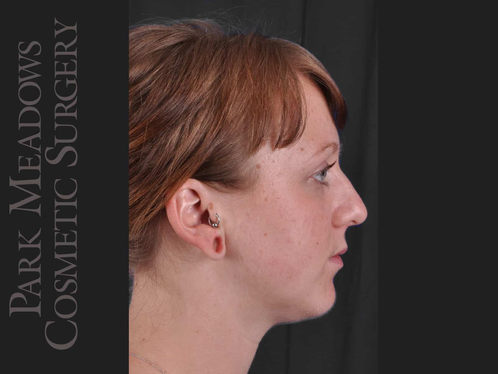 Before Image: Ear Gauge Repair - right-side