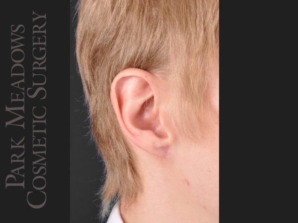 After Image: Ear Gauge Repair - right-front-oblique