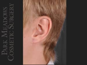 Ear Gauge Repair