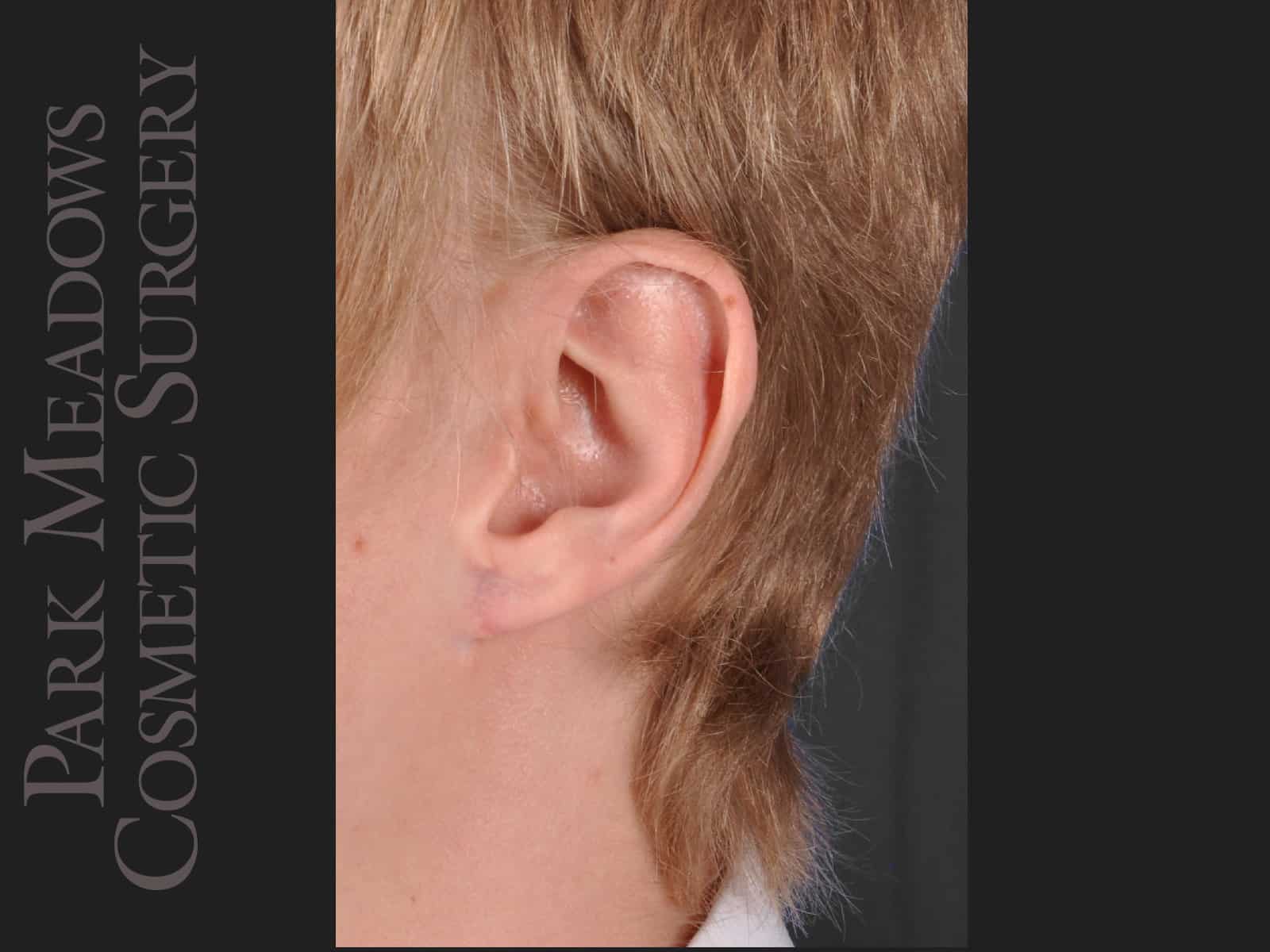 After Image: Ear Gauge Repair - left-front-oblique
