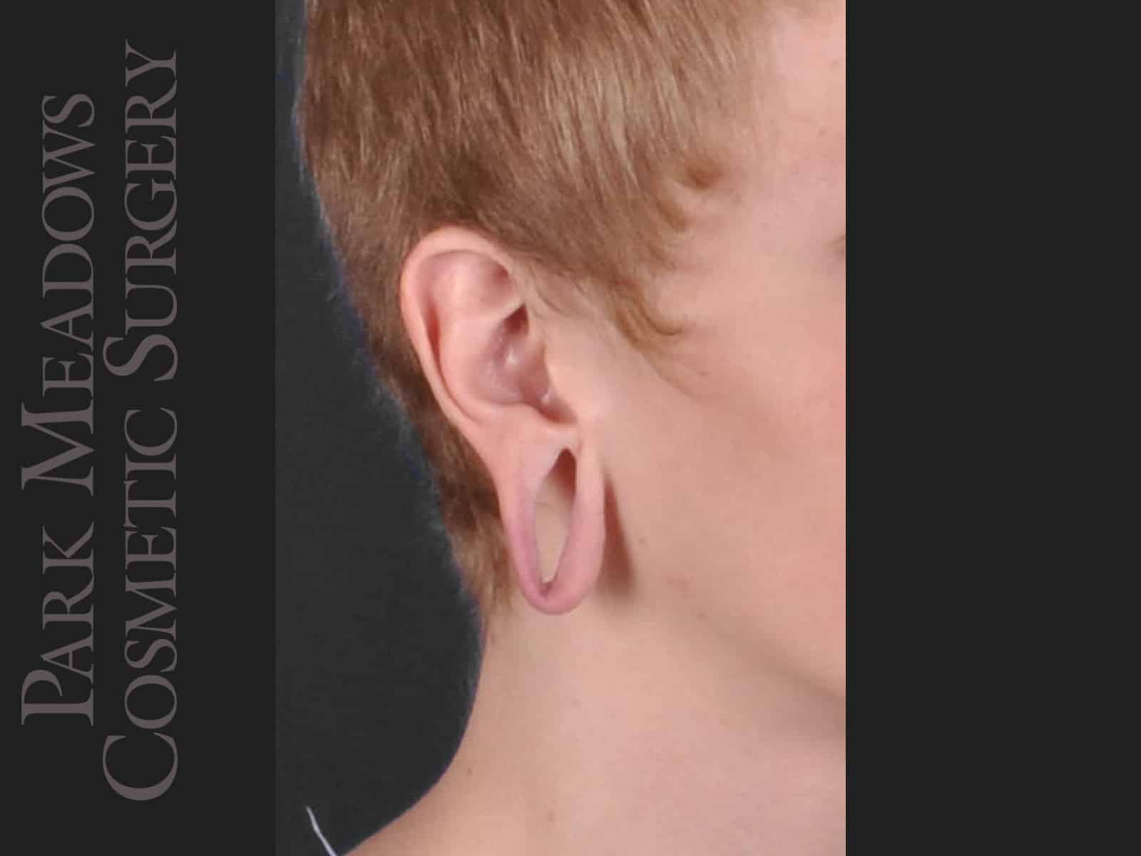 Before Image: Ear Gauge Repair - right-front-oblique