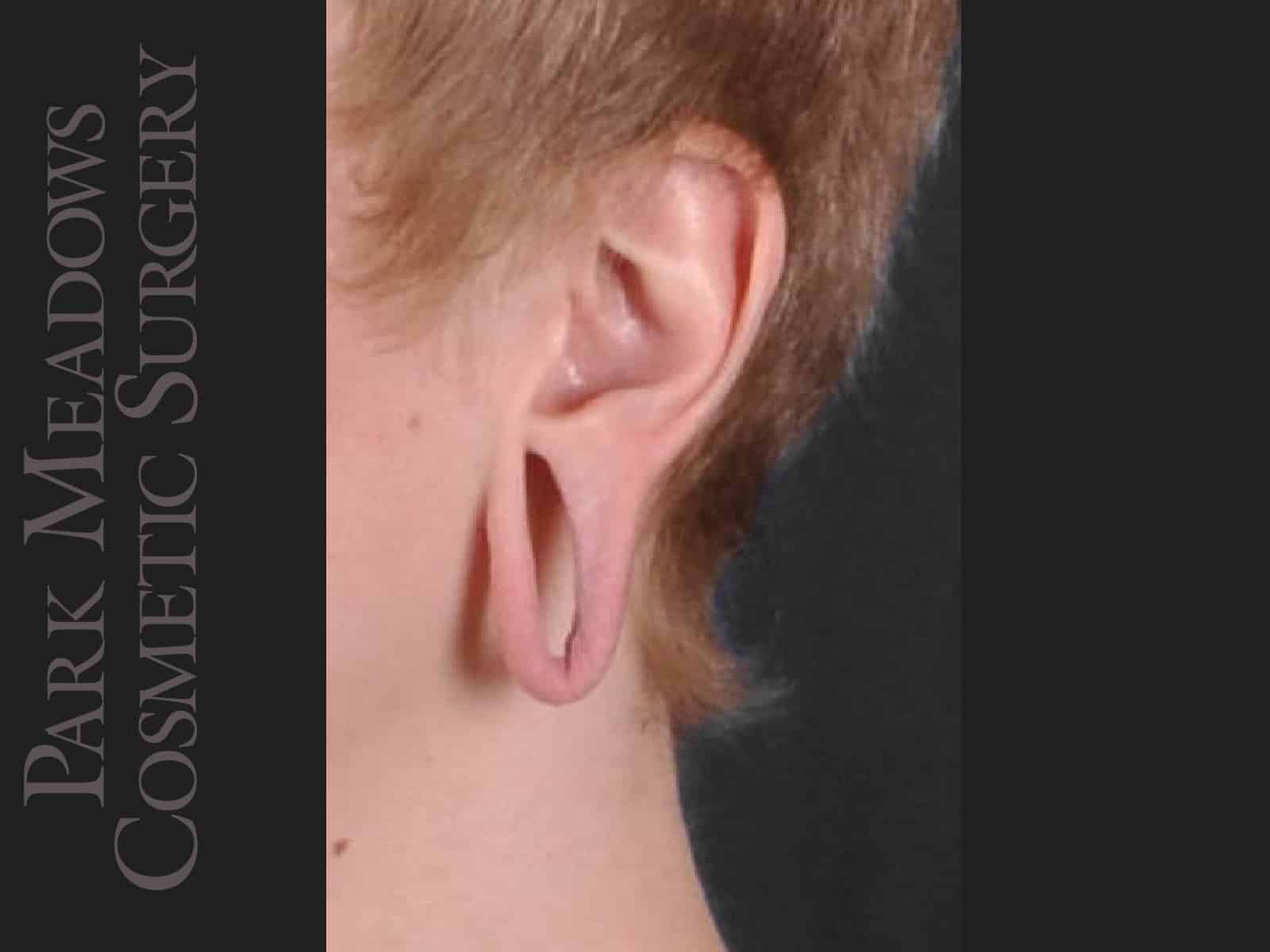 Before Image: Ear Gauge Repair - left-front-oblique