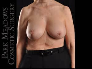 Breast Implant Exchange