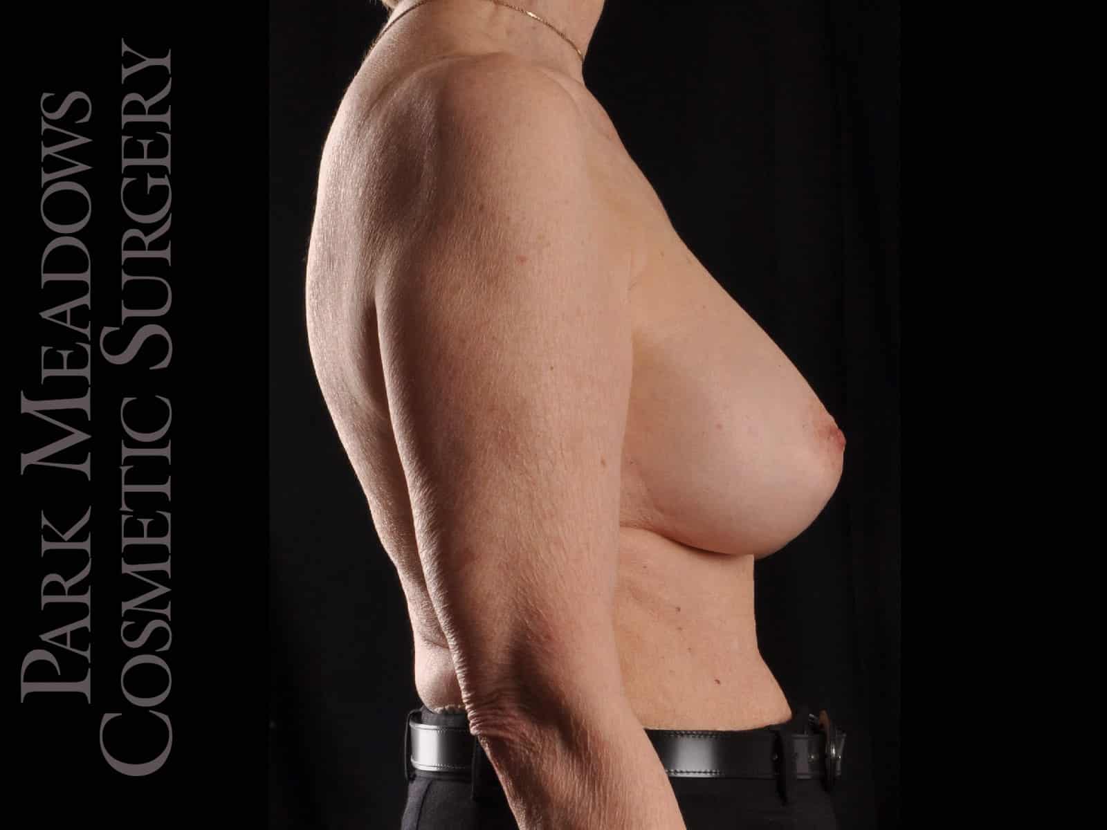 After Image: Breast Implant Exchange - right-side