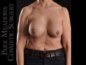 Breast Implant Exchange