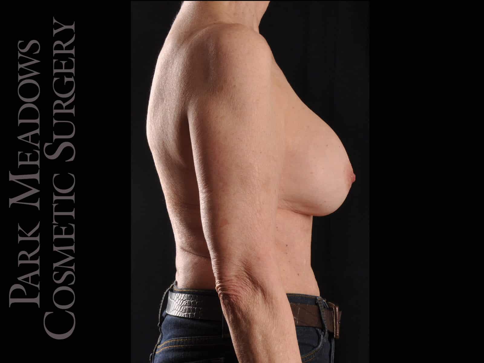 Before Image: Breast Implant Exchange - right-side
