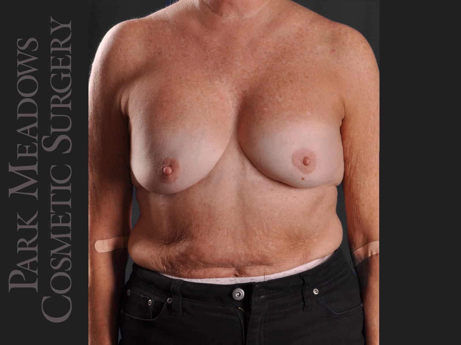 Failed Silicone Implant; Breast Implant Exchange with Capsulectomy; 400cc Silicone Implants