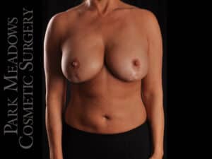 Mastopexy (Breast lift)