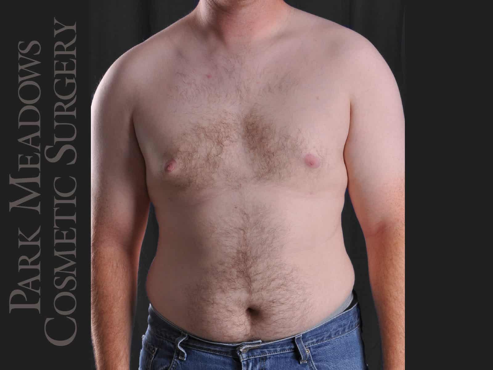 After Image: Gynecomastia – Direct Excision and Liposuction - front