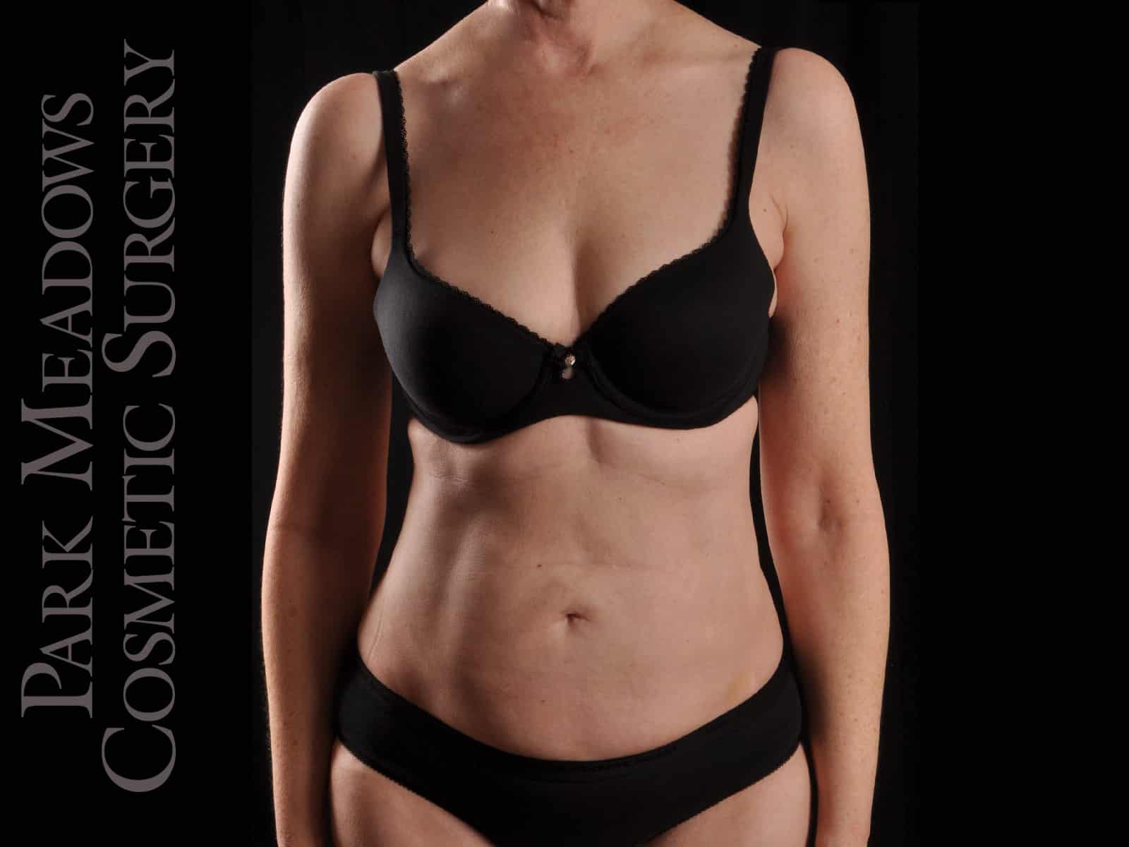 After Image: Liposuction - front