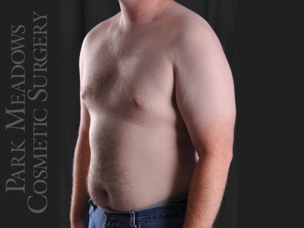 After Image: Gynecomastia – Direct Excision and Liposuction - left-front-oblique