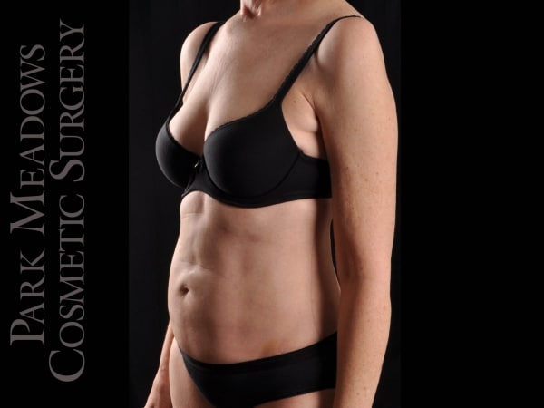 After Image: Liposuction - left-front-oblique
