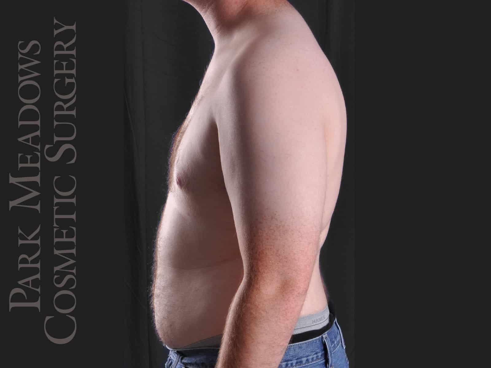 After Image: Gynecomastia – Direct Excision and Liposuction - left-side