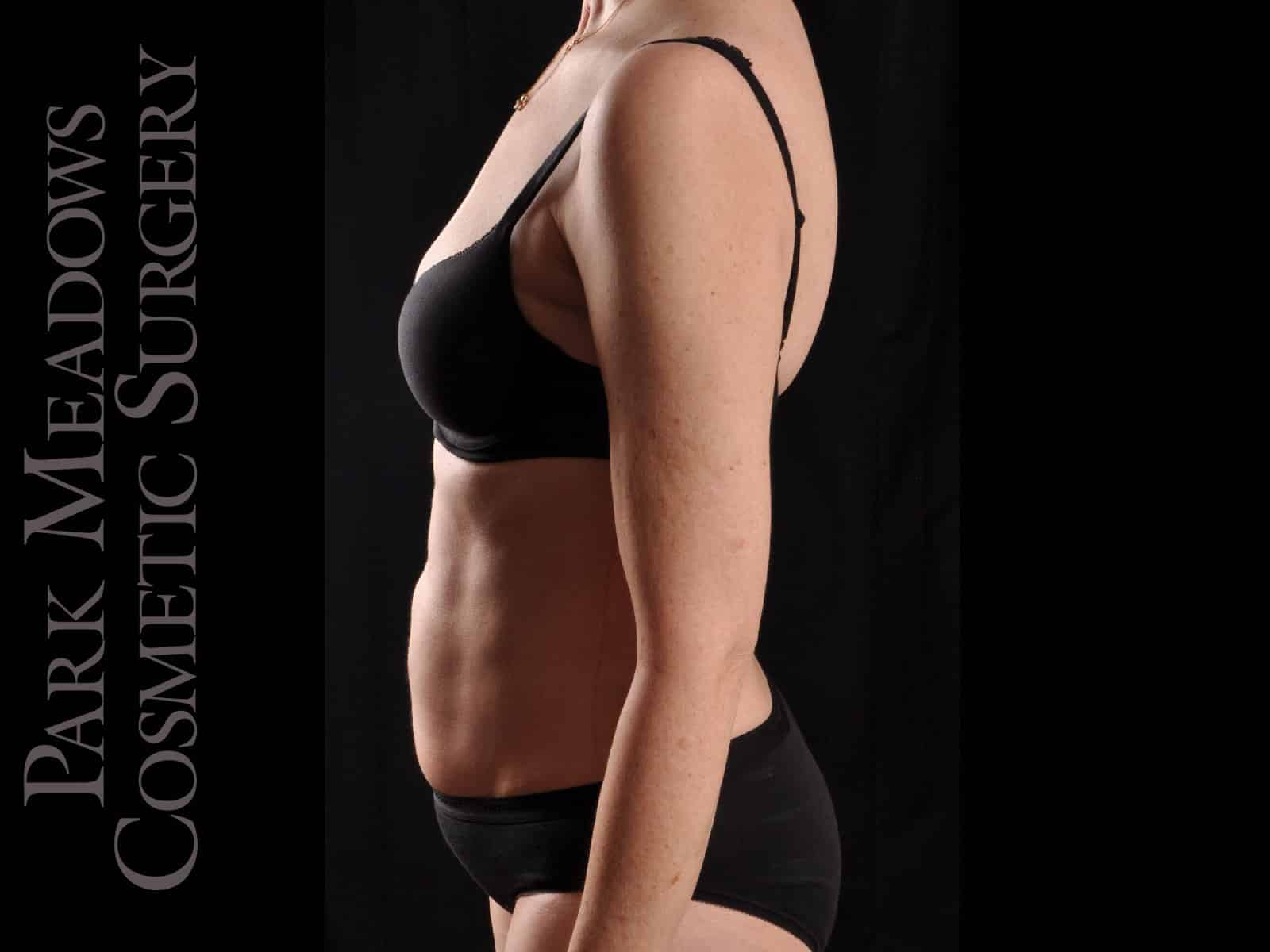 After Image: Liposuction - left-side