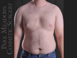 Gynecomastia – Direct Excision and Liposuction