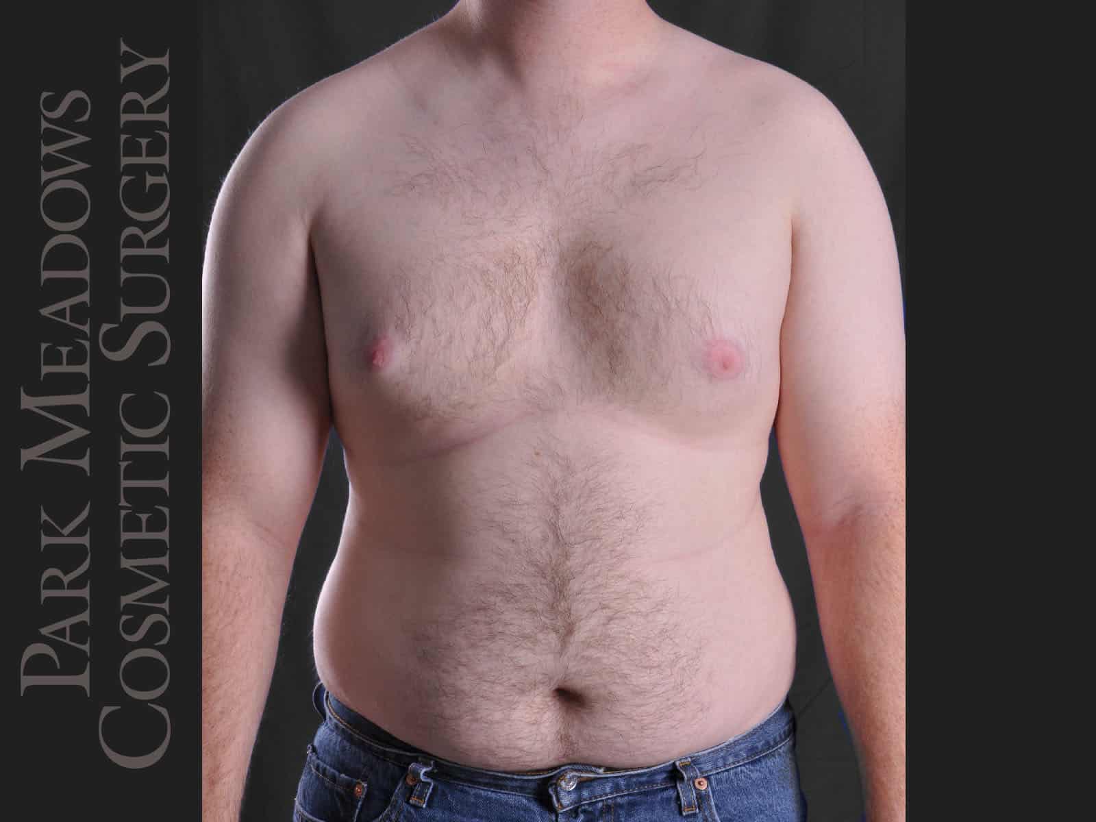 Before Image: Gynecomastia – Direct Excision and Liposuction - front
