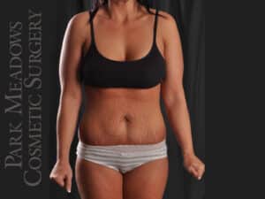 Liposuction of Flanks, Inner & Outer Thighs