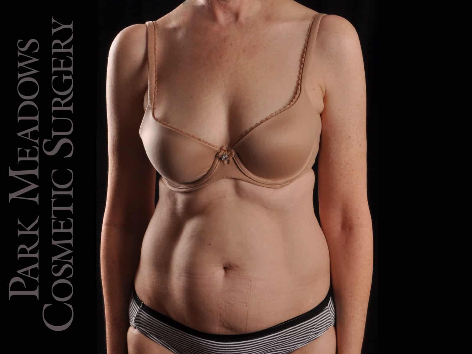 Before Image: Liposuction - front