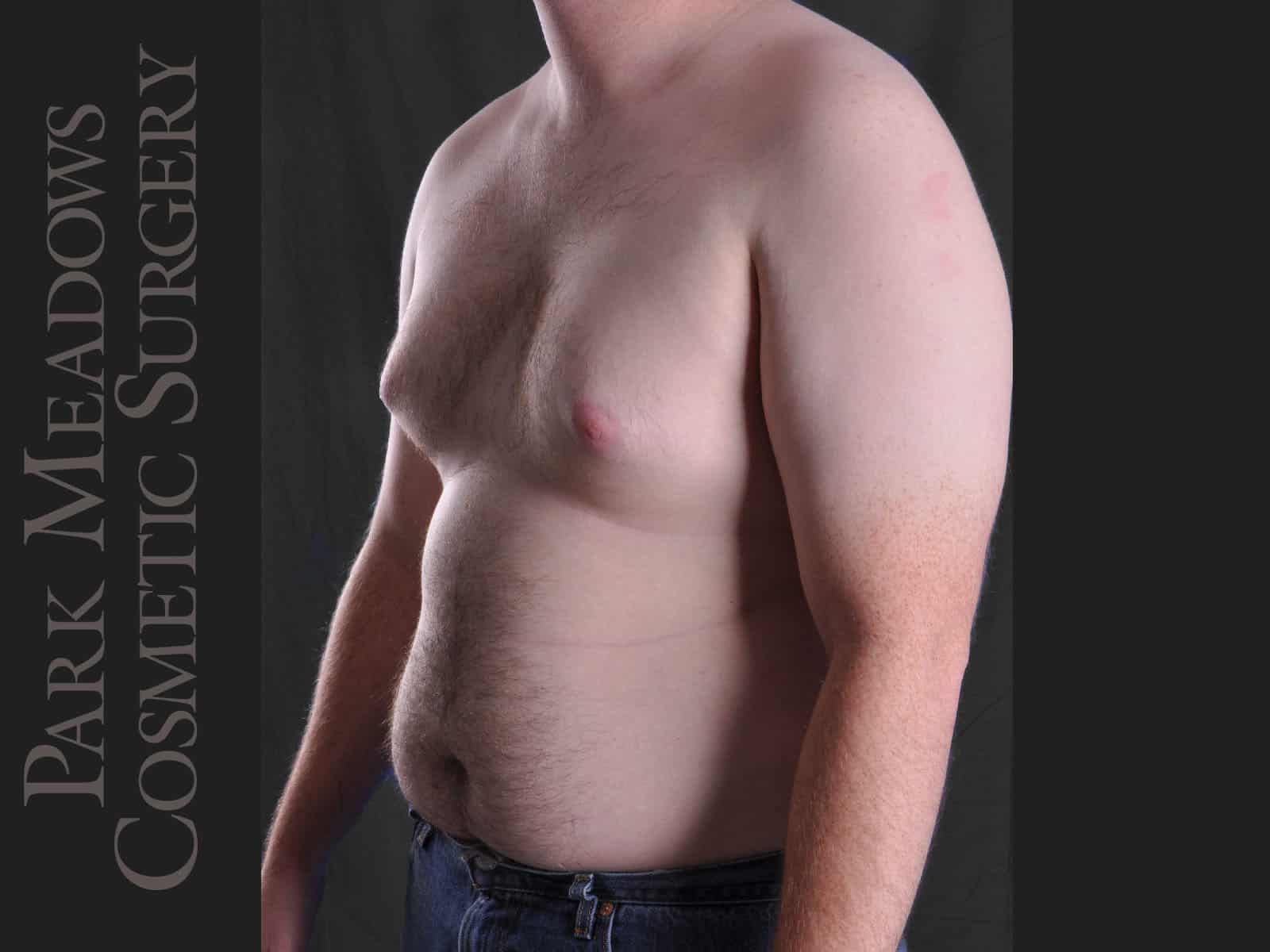 Before Image: Gynecomastia – Direct Excision and Liposuction - left-front-oblique