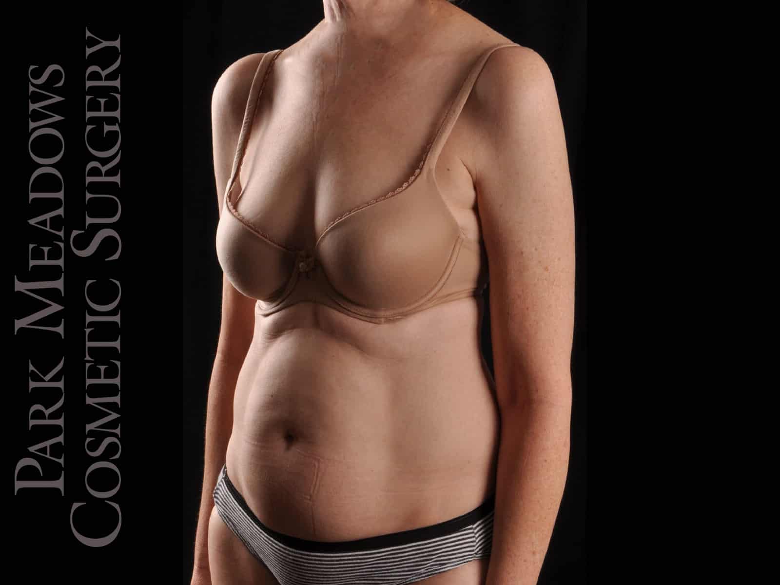 Before Image: Liposuction - left-front-oblique