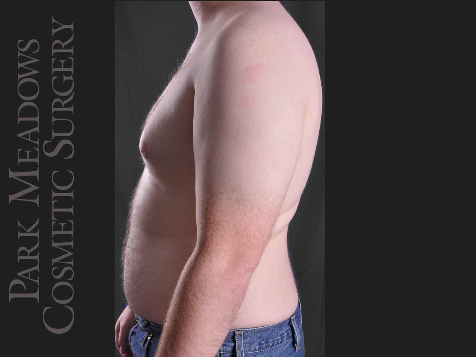 Before Image: Gynecomastia – Direct Excision and Liposuction - left-side