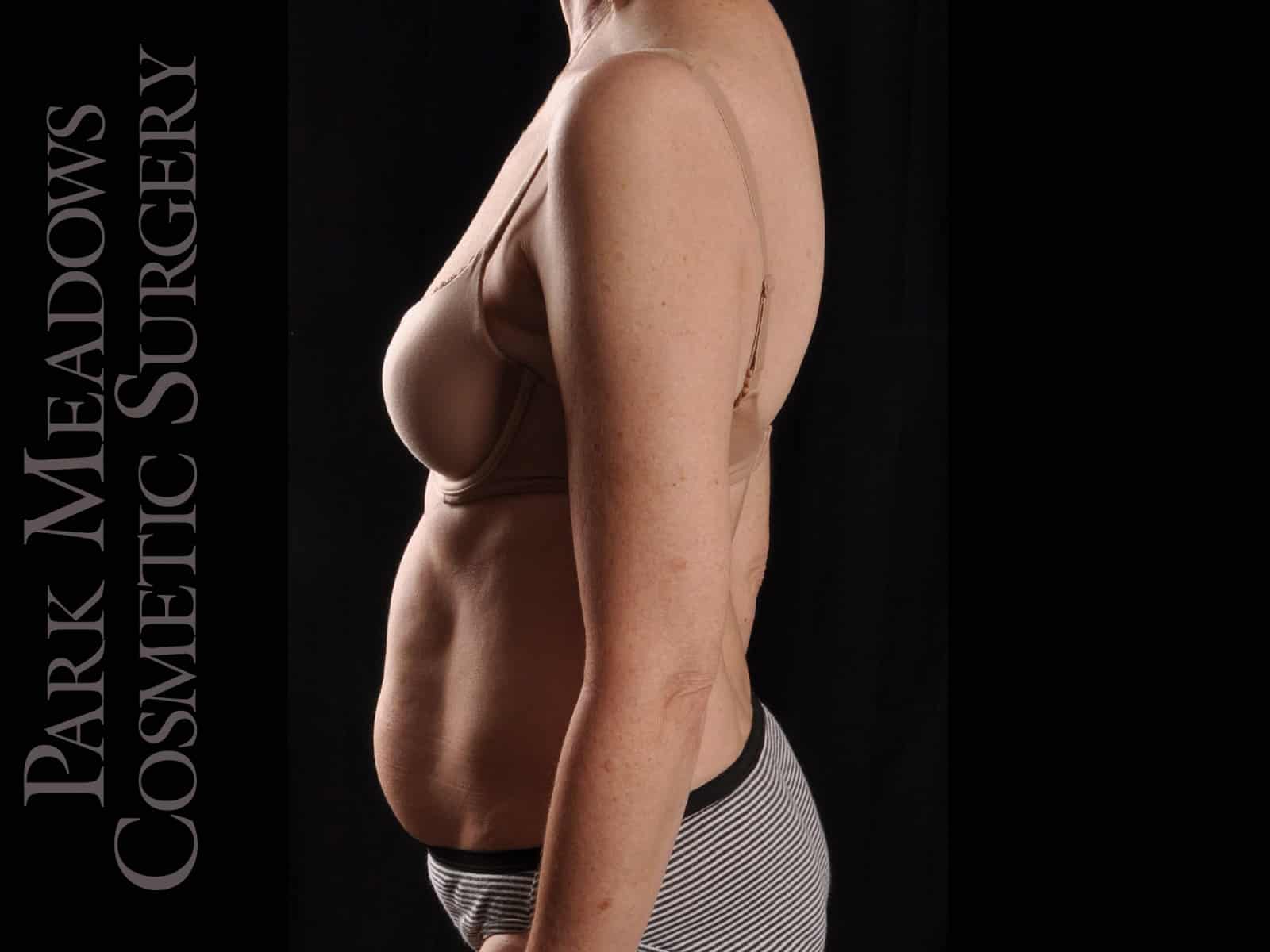 Before Image: Liposuction - left-side
