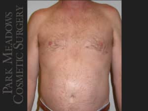 Gynecomastia – Direct Excision and Liposuction
