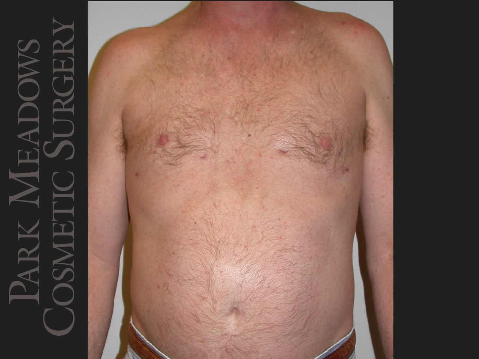After Image: Gynecomastia – Direct Excision and Liposuction - front