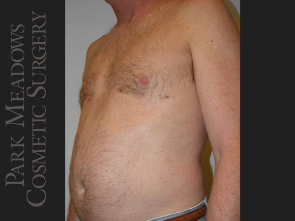 After Image: Gynecomastia – Direct Excision and Liposuction - left-front-oblique
