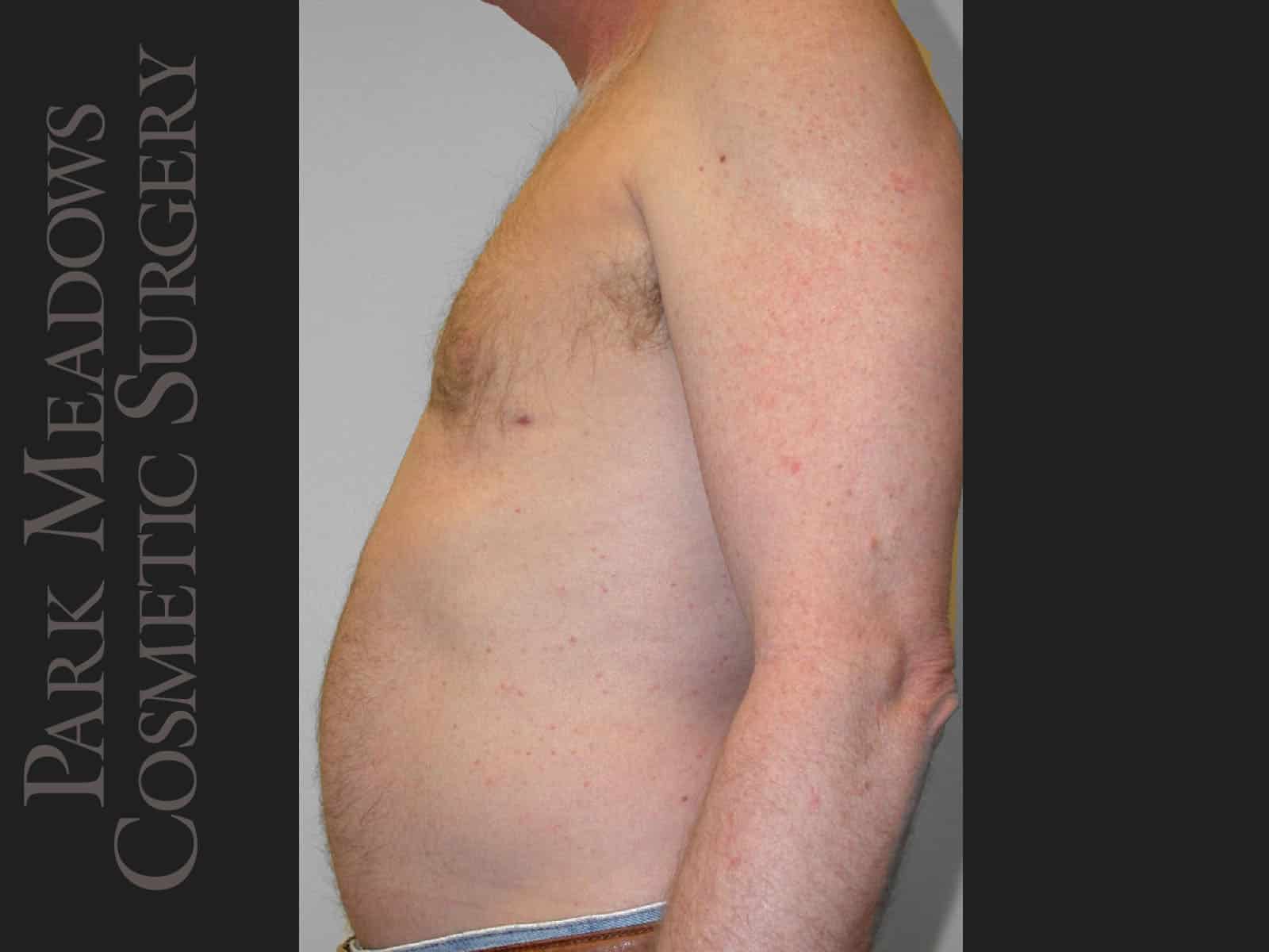 After Image: Gynecomastia – Direct Excision and Liposuction - left-side