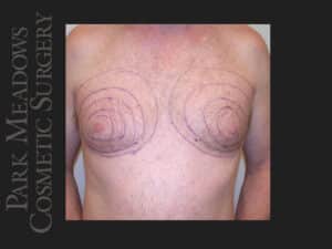 Liposuction 02 b1 1