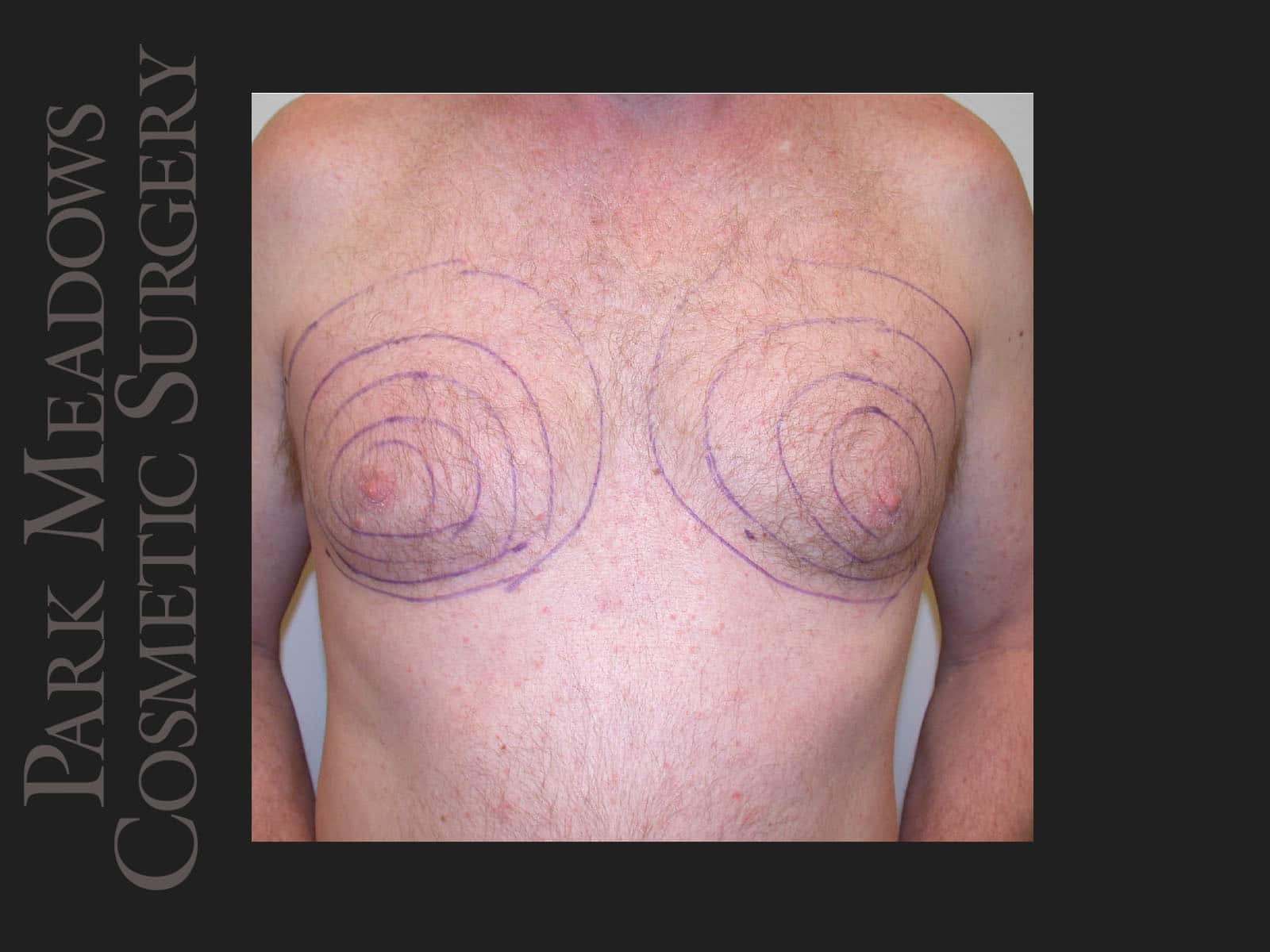 Before Image: Gynecomastia – Direct Excision and Liposuction - front