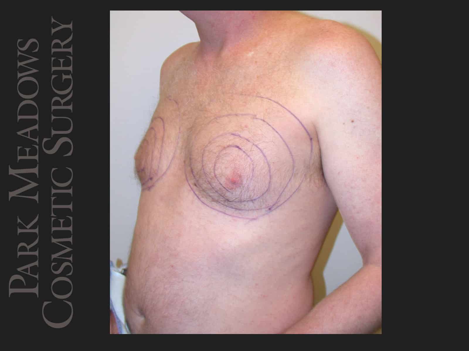 Before Image: Gynecomastia – Direct Excision and Liposuction - left-front-oblique