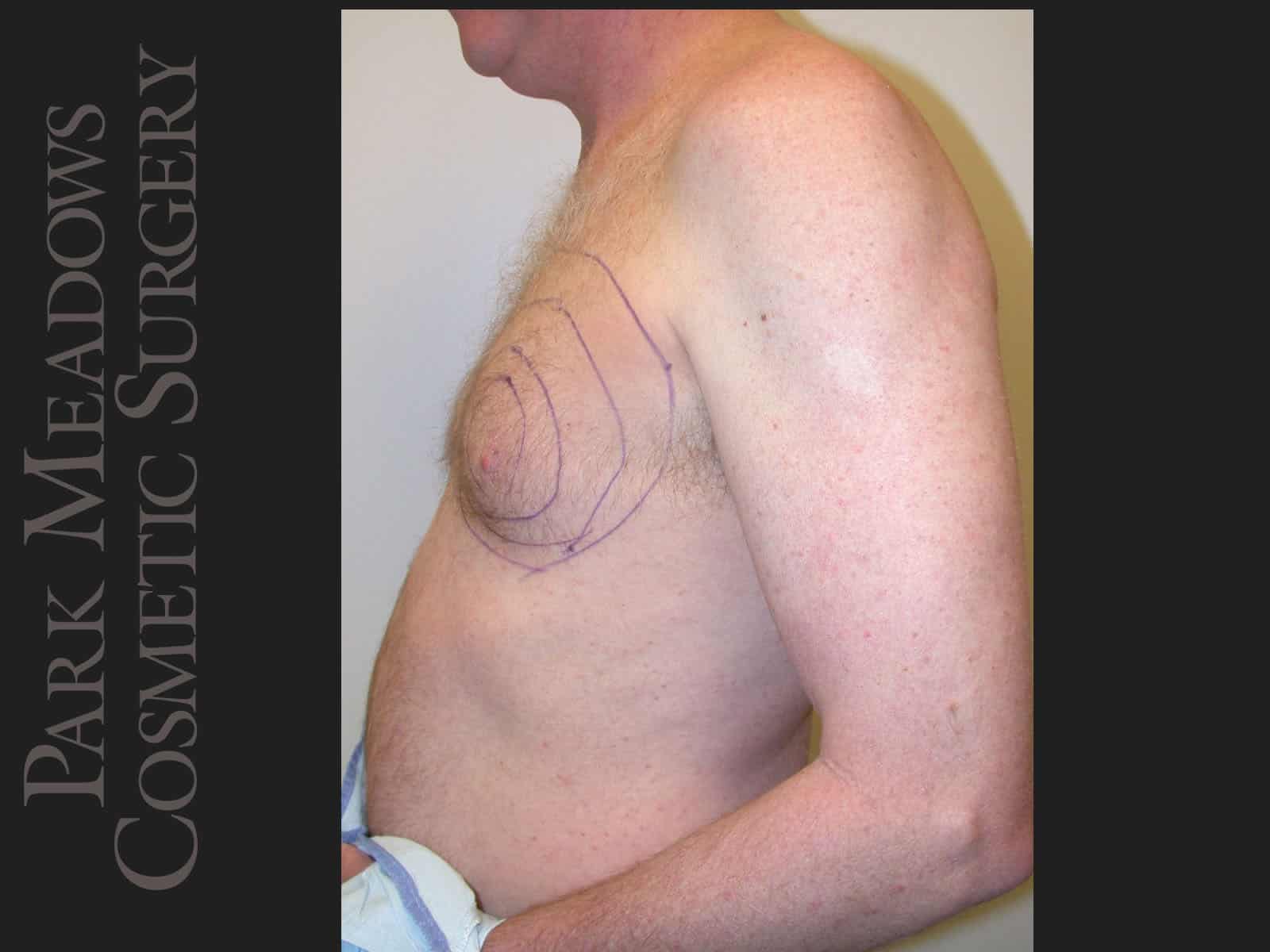 Before Image: Gynecomastia – Direct Excision and Liposuction - left-side