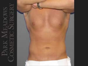 Liposuction of Flanks & Abdomen
