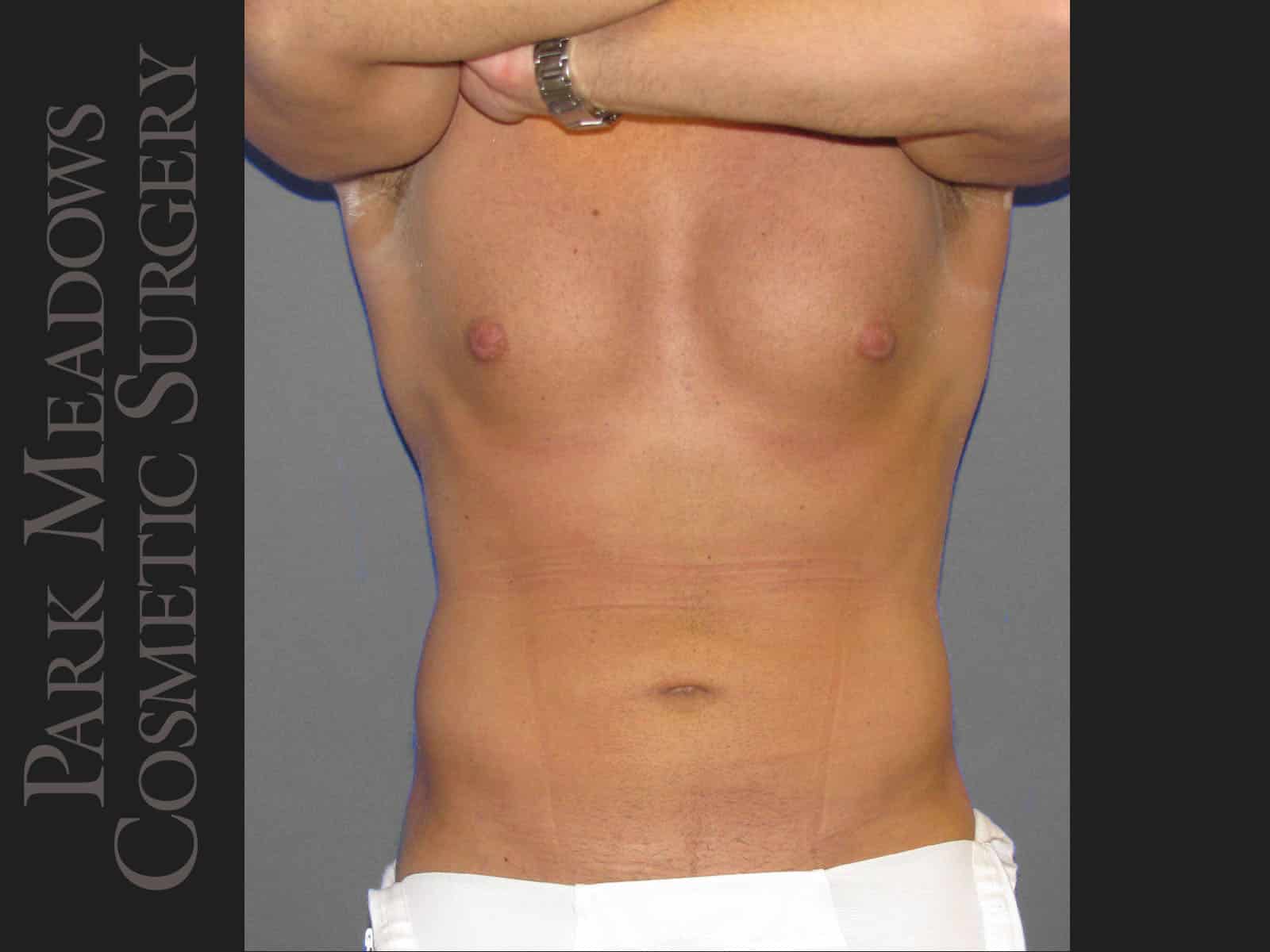 After Image: Liposuction of Flanks & Abdomen - front