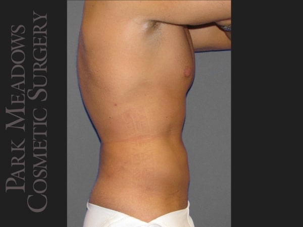 After Image: Liposuction of Flanks & Abdomen - right-side