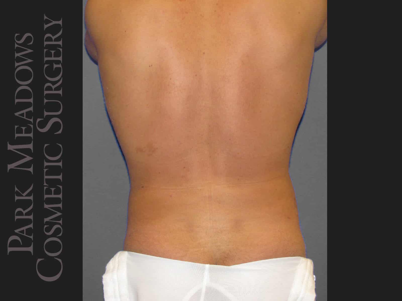 After Image: Liposuction of Flanks & Abdomen - back