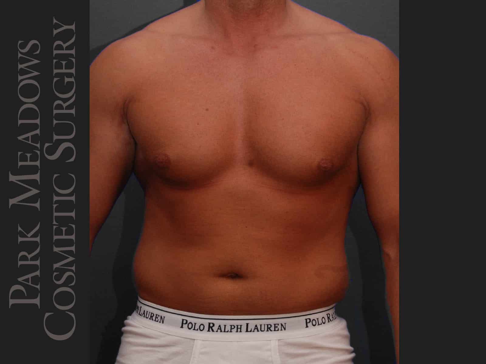 Before Image: Liposuction of Flanks & Abdomen - front