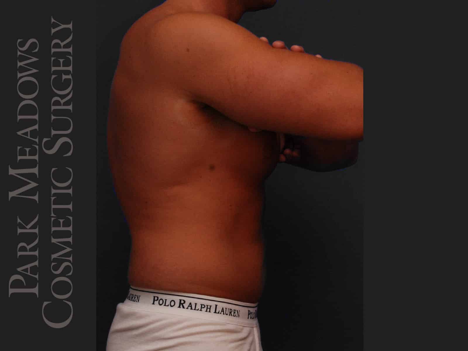 Before Image: Liposuction of Flanks & Abdomen - right-side