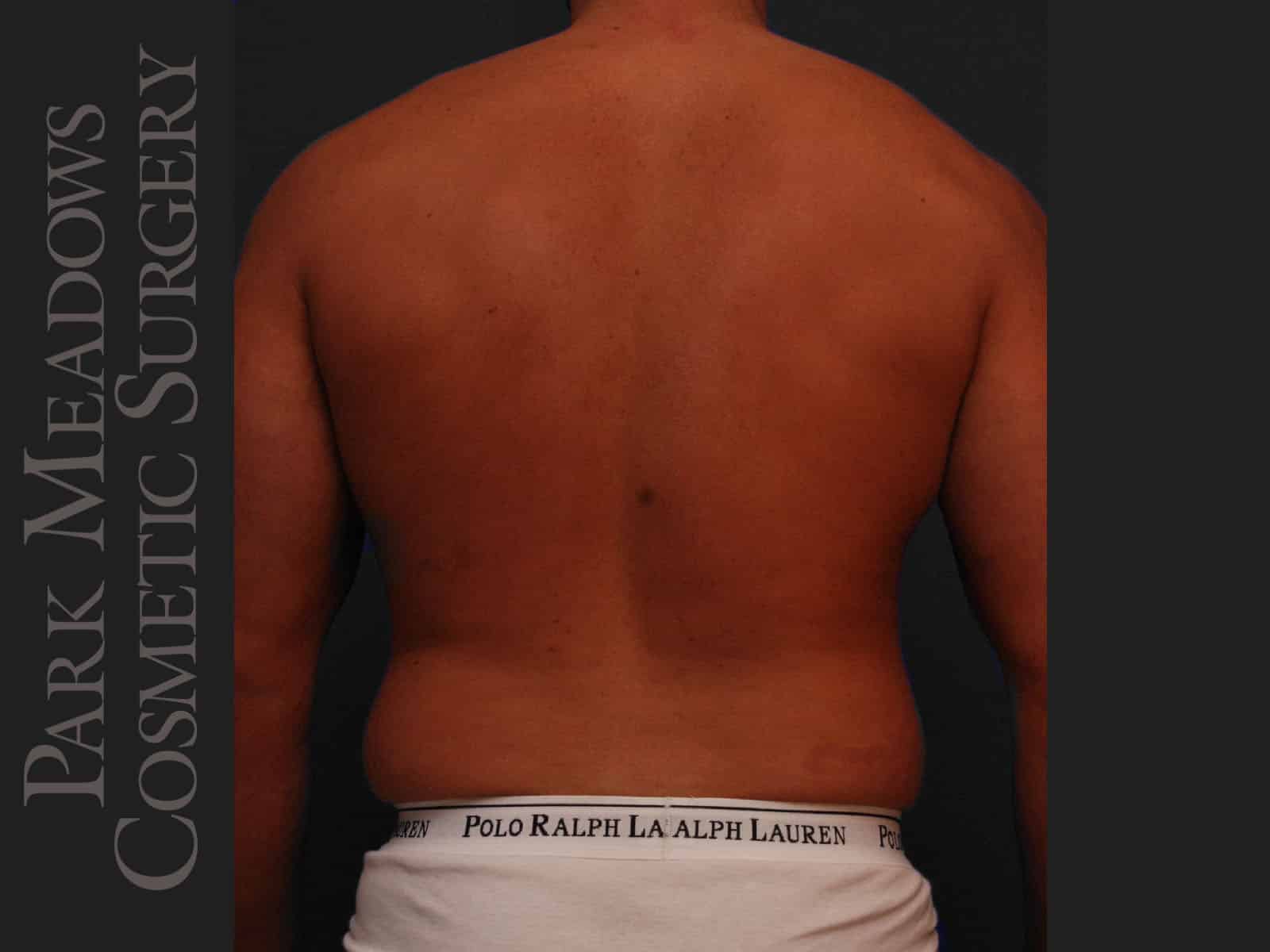 Before Image: Liposuction of Flanks & Abdomen - back