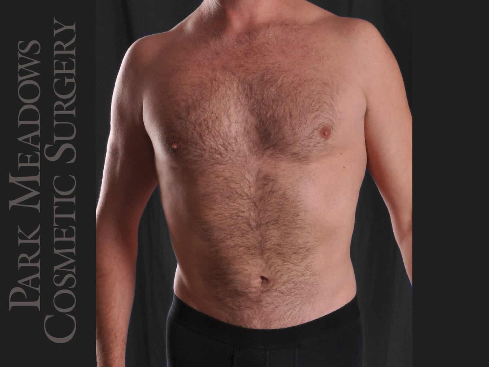 After Image: Liposuction - front