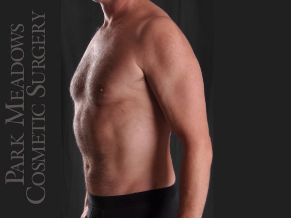 After Image: Liposuction - left-front-oblique