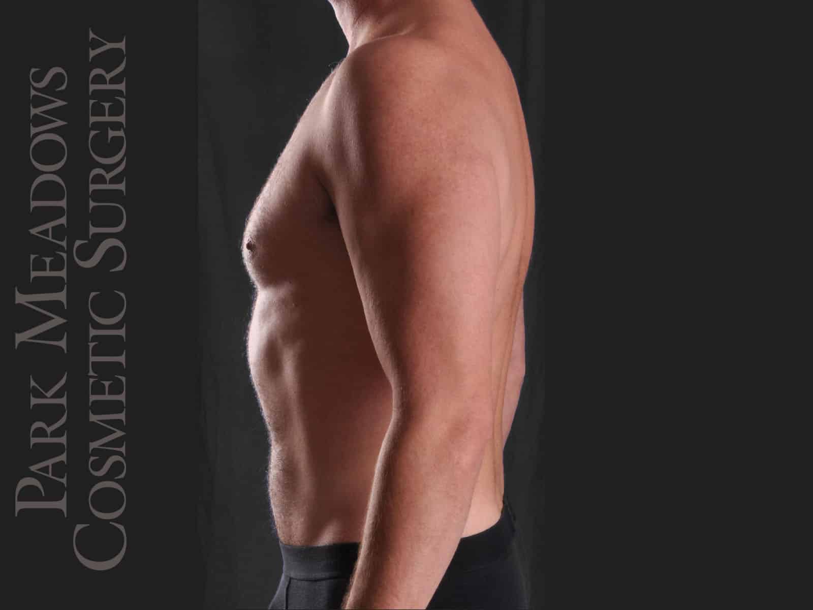 After Image: Liposuction - left-side