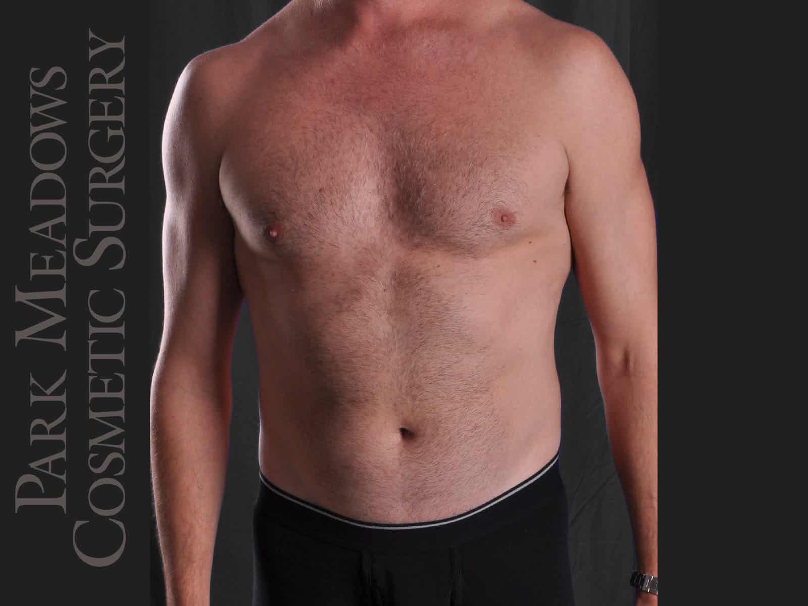 Before Image: Liposuction - front