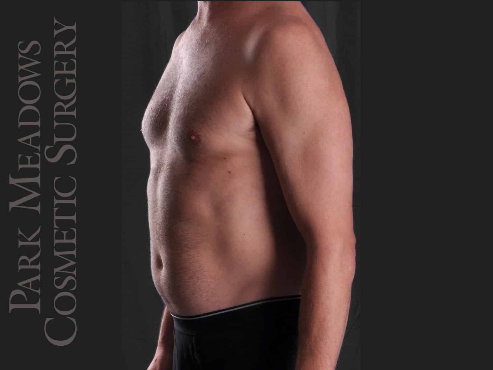 Before Image: Liposuction - left-front-oblique
